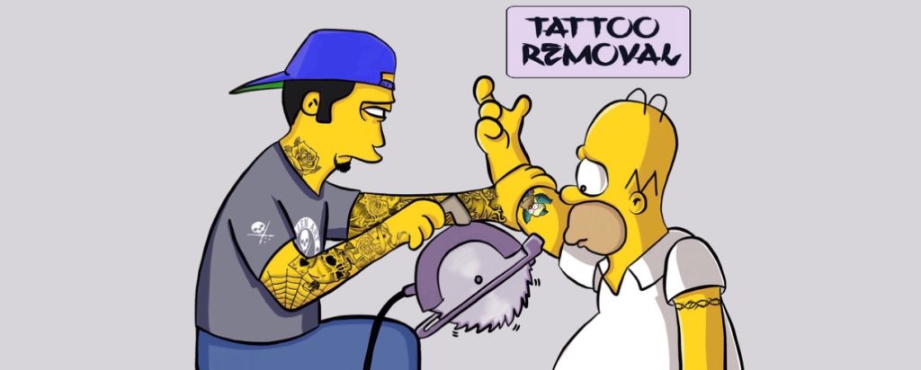 Simpson's tattoo removal