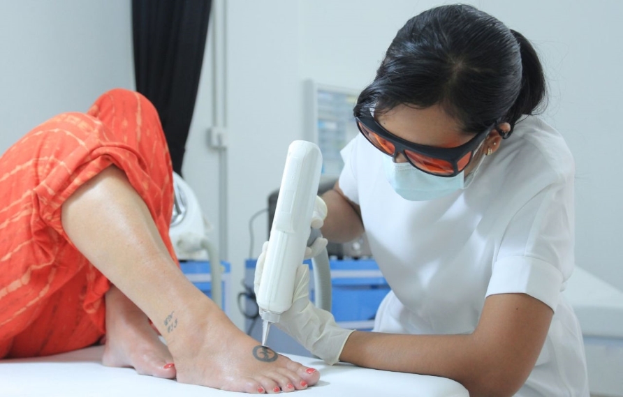 laser tattoo removal treatment